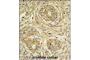 SUPV3L1 Antibody IHC analysis in formalin fixed and paraffin embedded prostate carcinoma followed by peroxidase conjugation of the secondary antibody and DAB staining. (SUPV3L1 anticorps  (N-Term))