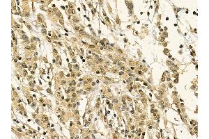 Hsp90 alpha Mouse Monoclonal Antibody at 1/100 staining human gastric cancer by IHC-P.
