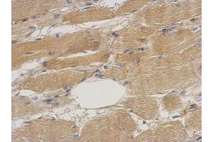 IHC-P Image Immunohistochemical analysis of paraffin-embedded human gastric cancer, using Septin 2, antibody at 1:500 dilution.