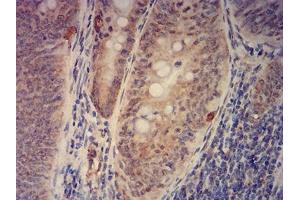 Immunohistochemical analysis of paraffin-embedded rectum cancer tissues using KAT2B mouse mAb with DAB staining. (KAT2B anticorps  (AA 1-142))