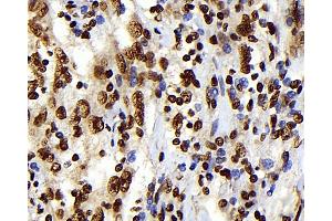 Immunohistochemistry analysis of paraffin-embedded human lymphoma using S100A4 Monoclonal Antibody at dilution of 1:300. (s100a4 anticorps)