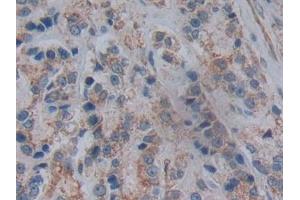 Detection of NT5C3 in Human Prostate cancer Tissue using Polyclonal Antibody to 5'-Nucleotidase, Cytosolic III (NT5C3)