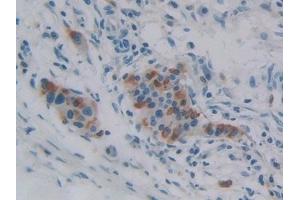 Detection of iPLA2 in Human Pancreatic cancer Tissue using Polyclonal Antibody to Phospholipase A2, Calcium Independent (iPLA2) (PNPLA2 anticorps  (AA 484-701))