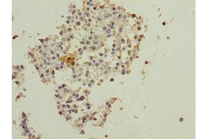 Immunohistochemistry of paraffin-embedded human breast cancer using ABIN7150890 at dilution of 1:100