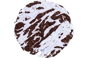 Muscle invasive urothelial carcinoma of the urinary bladder showing a strong S100P immunostaining of tumor cells