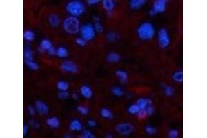 Immunofluorescence analysis of Human liver cancer tissue using TTR Monoclonal Antibody at dilution of 1:200. (TTR anticorps)