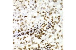 Immunohistochemistry of paraffin-embedded human kidney cancer using NFKB2 Antibody.
