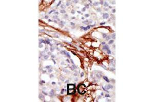 Formalin-fixed and paraffin-embedded human cancer tissue reacted with YES1 polyclonal antibody  , which was peroxidase-conjugated to the secondary antibody, followed by AEC staining. (YES1 anticorps  (N-Term))