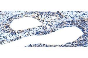 Immunohistochemistry of paraffin-embedded Human cervical cancer tissue using IRF5 Polyclonal Antibody at dilution of 1:25(x200)