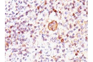 Formalin-fixed, paraffin-embedded human Hodgkin's Lymphoma stained with Bax Mouse Monoclonal Antibody (2D2). (BAX anticorps  (AA 3-16))