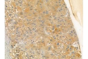 ABIN6257515 and ABIN6275540 at 1/100 staining human hepatocellular carcinoma by IHC-P. (TAO Kinase 1 (TAOK1) (Internal Region) anticorps)