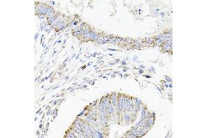 Immunohistochemistry of paraffin-embedded human colon carcinoma using SDC2 antibody at dilution of 1:100 (x40 lens). (Syndecan 2 anticorps)