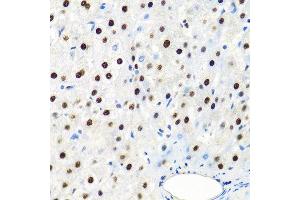 Immunohistochemistry of paraffin-embedded human liver cancer using SSB antibody at dilution of 1:100 (40x lens). (SSB anticorps)