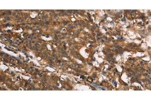 Immunohistochemistry of paraffin-embedded Human gastic cancer using MARC1 Polyclonal Antibody at dilution of 1:40 (MOSC1 anticorps)