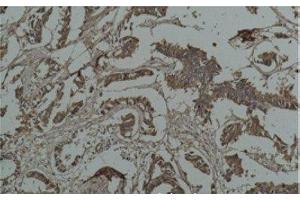 Immunohistochemistry of paraffin-embedded Human breast carcinoma tissue using HSP27 Monoclonal Antibody at dilution of 1:200. (HSP27 anticorps)