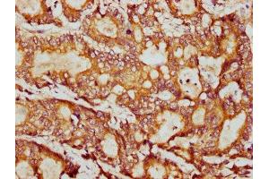 IHC image of ABIN7164994 diluted at 1:400 and staining in paraffin-embedded human colon cancer performed on a Leica BondTM system.