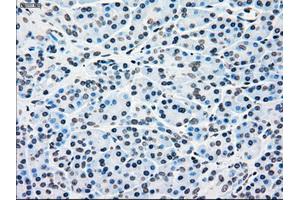 Immunohistochemical staining of paraffin-embedded Adenocarcinoma of breast tissue using anti-BRAF mouse monoclonal antibody. (BRAF anticorps)