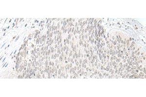 Immunohistochemistry of paraffin-embedded Human esophagus cancer tissue using ORC1 Polyclonal Antibody at dilution of 1:65(x200) (ORC1 anticorps)