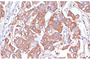 Immunohistochemistry of paraffin-embedded Human liver cancer using LRP1 Polyclonal Antibody at dilution of 1:100 (40x lens). (LRP1 anticorps)