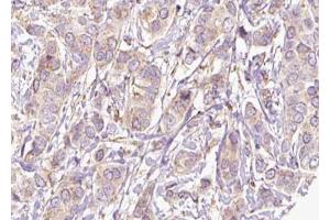 ABIN6273812 at 1/100 staining Human breast cancer tissue by IHC-P. (SRMS anticorps  (C-Term))