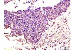 Formalin-fixed and paraffin embedded human lung carcinoma labeled with Anti-MuRF1/Trim63 Polyclonal Antibody, Unconjugated (ABIN715676) at 1:200 followed by conjugation to the secondary antibody and DAB staining.