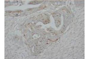 Immunohistochemical analysis of paraffin embedded HUman intestine cancer sections using P73alpha antibody (Tumor Protein p73 anticorps  (C-Term))