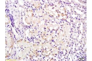Formalin-fixed and paraffin embedded human laryngeal carcinoma labeled with Anti-FPR1 Polyclonal Antibody, Unconjugated (ABIN742245) at 1:200 followed by conjugation to the secondary antibody and DAB staining (FPR1 anticorps)