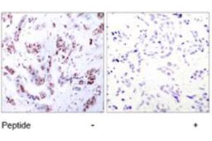 Immunohistochemical analysis of paraffin-embedded human breast carcinoma tissue using MEF2A polyclonal antibody  .