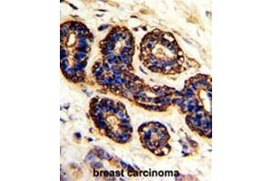 Formalin-fixed and paraffin-embedded human breast carcinoma with BEST2 Antibody (C-term), which was peroxidase-conjugated to the secondary antibody, followed by DAB staining. (Bestrophin 2 anticorps  (C-Term))