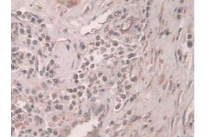 Detection of PCI in Human Prostate Gland Cancer Tissue using Polyclonal Antibody to Protein C Inhibitor (PCI)