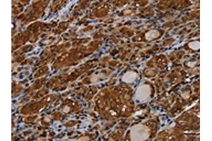 The image on the left is immunohistochemistry of paraffin-embedded Human thyroid cancer tissue using ABIN7191558(MYBBP1A Antibody) at dilution 1/40, on the right is treated with synthetic peptide. (MYBBP1A anticorps)