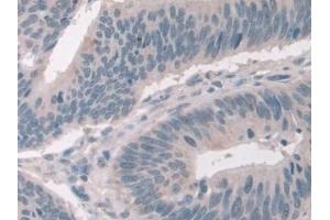 Detection of NCOA3 in Human Colorectal cancer Tissue using Polyclonal Antibody to Nuclear Receptor Coactivator 3 (NCOA3)