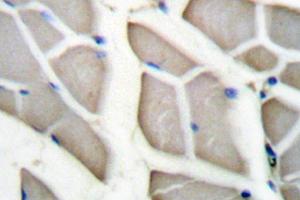 Immunohistochemistry (IHC) analyzes of 14-3-3 ζ (pVal52) antibody in paraffin-embedded human breast carcinoma tissue. (14-3-3 zeta anticorps)
