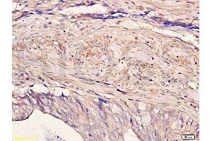 Formalin-fixed and paraffin embedded human colon carcinoma with Anti-Pokemon Polyclonal Antibody, Unconjugated (ABIN729448) at 1:200, followed by conjugation to the secondary antibody and DAB staining (ZBTB7A anticorps  (AA 151-250))