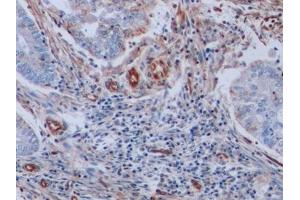 Detection of VIM in Human Endometrial cancer Tissue using Monoclonal Antibody to Vimentin (VIM)