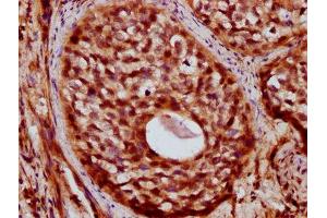 IHC image of ABIN7176036 diluted at 1:400 and staining in paraffin-embedded human cervical cancer performed on a Leica BondTM system.