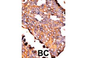 Formalin-fixed and paraffin-embedded human cancer tissue reacted with RFK polyclonal antibody  , which was peroxidase-conjugated to the secondary antibody, followed by AEC staining. (Riboflavin Kinase anticorps  (N-Term))