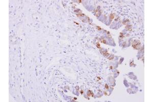 IHC-P Image POR antibody detects POR protein at cytoplasm on human ovarian carcinoma by immunohistochemical analysis. (POR anticorps  (N-Term))