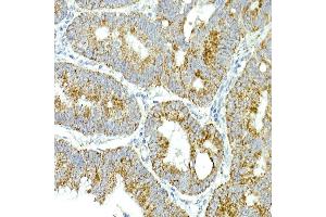 Immunohistochemistry of paraffin-embedded human colon carcinoma using MRPS15 Rabbit mAb (ABIN7268582) at dilution of 1:250 (40x lens). (MRPS15 anticorps)