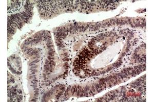 Immunohistochemistry (IHC) analysis of paraffin-embedded Human Colon Cancer, antibody was diluted at 1:100. (Histone H2A anticorps  (Internal Region))