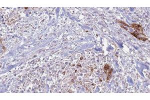 ABIN6277697 at 1/100 staining Human urothelial cancer tissue by IHC-P. (Integrin Alpha2b anticorps  (Internal Region))
