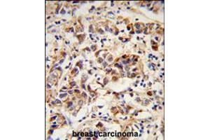 Formalin-fixed and paraffin-embedded human breast carcinoma reacted with SPRR1B Antibody , which was peroxidase-conjugated to the secondary antibody, followed by DAB staining. (SPRR1B anticorps  (C-Term))