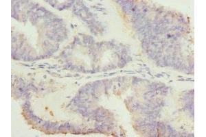 Immunohistochemistry of paraffin-embedded human endometrial cancer using ABIN7167620 at dilution of 1:100 (RGS7 anticorps  (AA 1-300))