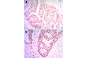 Immunohistochemical analysis of paraffin-embedded human colon cancer tissue (A) and ovary cancer tissue (B) using THAP11 monoclonal antobody, clone 3F3  with DAB staining. (THAP11 anticorps)