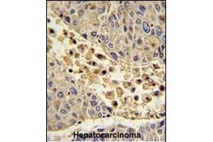 Formalin-fixed and paraffin-embedded human hepatocarcinoma with COLEC11 Antibody (N-term), which was peroxidase-conjugated to the secondary antibody, followed by DAB staining.