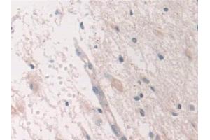 Detection of USP6NL in Human Glioma Tissue using Polyclonal Antibody to USP6 N-Terminal Like Protein (USP6NL) (USP6NL anticorps  (AA 1-292))