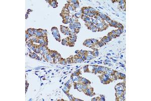 Immunohistochemistry of paraffin-embedded human gastric cancer using GIP antibody (ABIN1882357) at dilution of 1:100 (40x lens). (GIP anticorps)