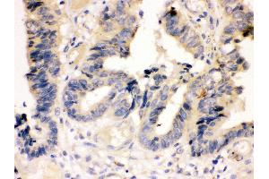 Anti-Caspase-7(P11) antibody, IHC(P) IHC(P): Human Intestinal Cancer Tissue