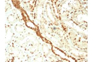 Formalin-fixed, paraffin-embedded human Renal Cell Carcinoma stained with Emerin Mouse Monoclonal Antibody (EMD/2168).