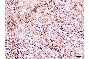 Formalin-fixed and paraffin embedded rat colon carcinoma labeled with Anti-Slc22A17 Y Polyclonal Antibody, Unconjugated (ABIN668691) at 1:300, followed by conjugation to the secondary antibody and DAB staining (SLC22A17 anticorps  (AA 475-538))